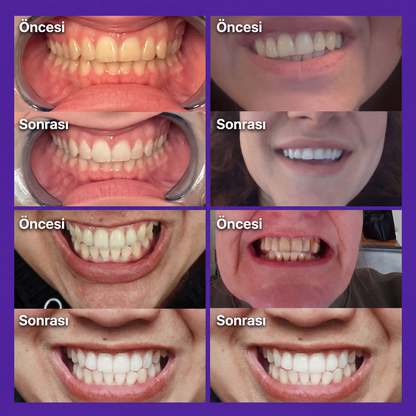 Diş beyazlatma şeritleri